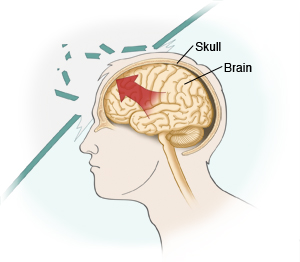 Person's head with inside view of skull and brain, showing injury to head.