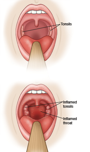 Two close-up views of the throat showing normal tonsils and inflamed tonsils and throat.