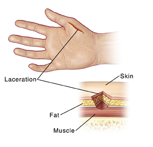 Laceration on hand, with detail of laceration showing location of skin, fat, and muscle.