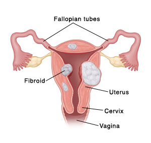 Cross section of uterus showing fibroids.