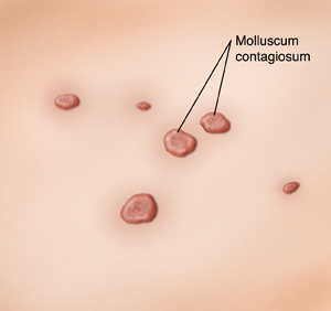 Close-up of raised bumps of molluscum contagiosum on skin.
