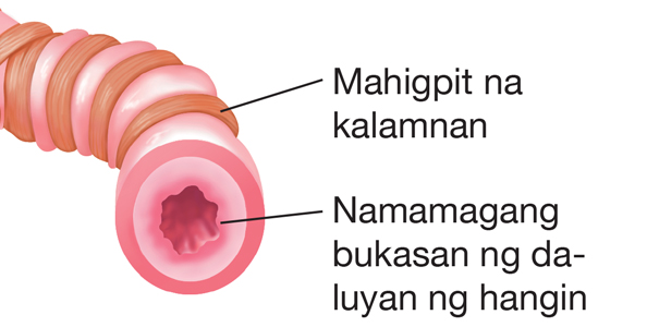 Lubhang mahigpit na kalamnan, labis na uhog, at magang lining ng daanan ng hangin (bronchial tube)