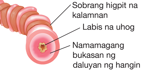 Lubhang mahigpit na kalamnan, labis na uhog, at magang lining ng daanan ng hangin (bronchial tube)