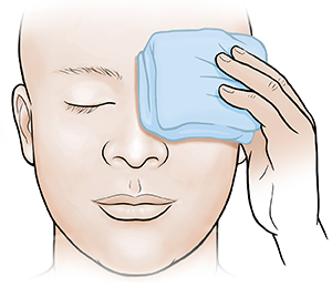 Person holding cold compress on closed eye.