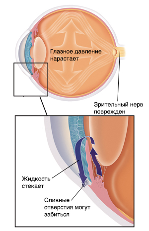 Поперечное сечение глаза: показано повышенное внутриглазное давление. На меньшем изображении показаны перекрытые пути оттока жидкости.