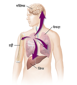 जिगर, अन्य फेफड़े, हड्डी और मस्तिष्क तक फैलते हुए फेफड़े के कैंसर को दर्शाते हुए तीरों के साथ पुरुष की रूपरेखा।