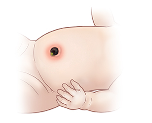 Baby's abdomen showing inflammation on belly around umbilical cord stump.