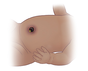 Baby's abdomen showing inflammation on belly around umbilical cord stump.