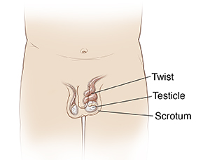 Front view of pelvic area showing testicular torsion.