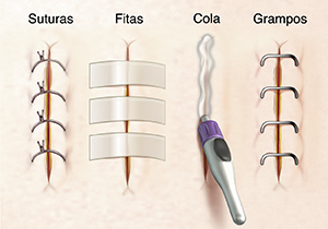 Detalhe da incisão mostrando pontos, fita cirúrgica, cola e grampos.