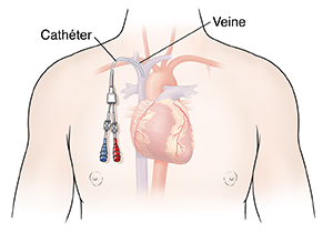Silhouette du thorax d’un homme montrant un cœur avec une voie centrale.