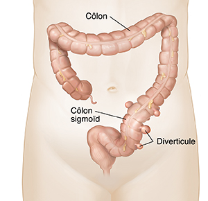 Vue antérieure du côlon avec des diverticules dans la partie inférieure.
