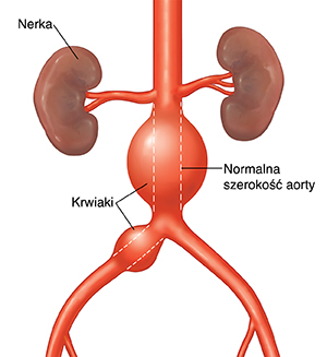 Widok aorty brzusznej z krwiakiem od przodu. Wykropkowana linia pokazuje normalną szerokość aorty.