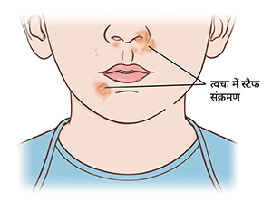 निचले चेहरे और गर्दन का क्लोज़अप। नाक और मुँह के पास दुःखदायी स्टैफ संक्रमण।