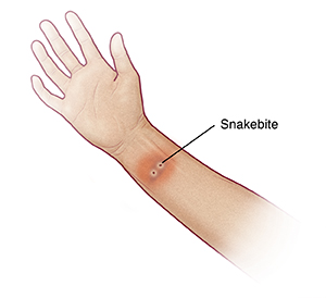 Arm with hand palm side up showing snakebite on wrist.