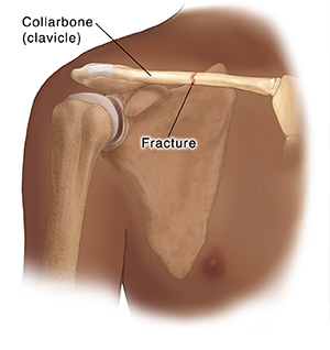Anterior view of shoulder joint showing a fracture in the clavicle.