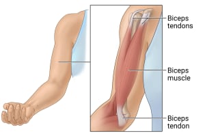 On the arm above the inside of the elbow, the biceps muscle sits between 2 biceps tendons at the shoulder and 1 biceps tendon at the elbow.