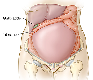 Front view of pregnant woman's uterus pressing on gallbladder.