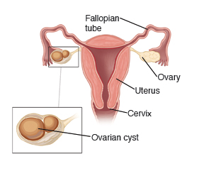 Cross-section of the uterus, with Fallopian tubes, cervix, ovaries, and closeup of ovarian cyst.