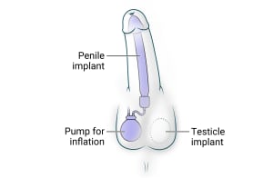Penile implant is embedded in the shaft. Testicle implant and a pump for inflation is also added in the scrotum.