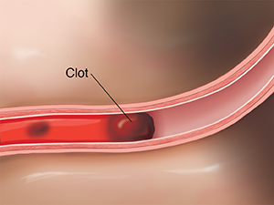 Cross section of artery in brain showing embolus blocking blood flow.
