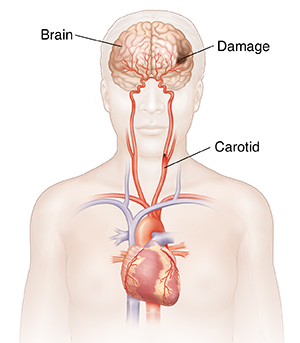 Front view of head and upper body showing heart, carotid arteries, and damage in brain.