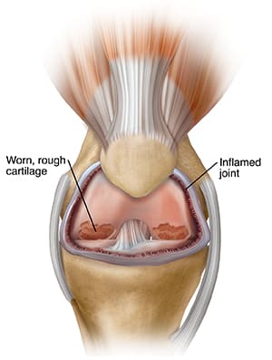 Knee with problems, showing worn, rough cartilage and inflamed joint.