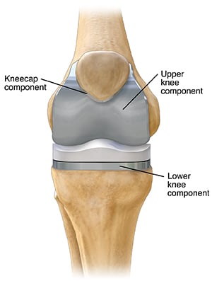 Knee after replacement with full knee prothesis, including kneecap, upper knee and lower knee components.