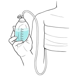 Bulb filled with fluid and held upright, with cap closed and tube connecting bulb to surgical site.