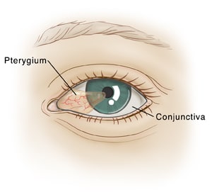 Eye showing pterygium and conjunctiva.