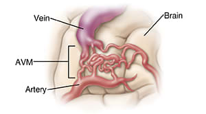 Closeup view of arteriovenous malformation (AVM) in the brain.
