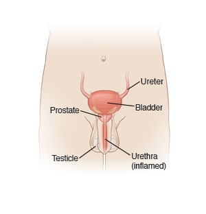 Male genitourinary system, with ureter, bladder, prostate, urethra, and testicle, showing inflamed urethra.