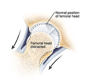 Cross section of hip joint with arrows showing femoral head of thighbone being pulled out of normal place in socket.