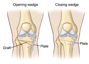Front view of bony structures of knees, showing open-wedge osteotomy with bone graft and plate and closed-wedge osteotomy with bone cut away and plate.