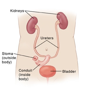 Urinary tract, showing bladder not connected to ureters, but kidneys connected  through ureters to conduit (inside body) to stoma (outside body).