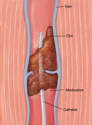 Cross section of vein with blood clot showing catheter releasing medication into clot