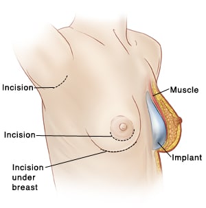 Breast implant incision options in armpit, at areola, or under breast, and breast implant in place.