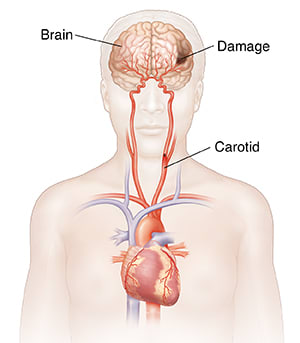 Front view of head and upper body showing heart, carotid arteries, and damage in brain.