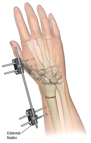 Forearm with external fixator holding fractured radius in place.