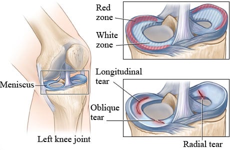 Location of meniscus in knee, with detail of meniscus and types of tears.