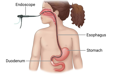 Front of child, showing endoscope with tip inserted through child's nose and into esophagus, stomach, and duodenum.