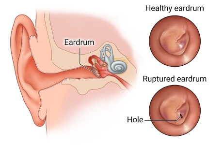Location of eardrum at end of ear canal, with details of healthy eardrum and of ruptured eardrum, showing hole.