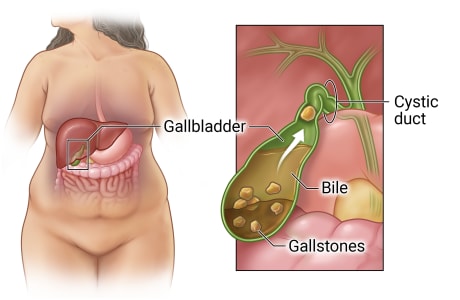 Location of gallbladder in belly with detail of gallbladder with gallstones in bile and cystic duct blocked by gallstone.