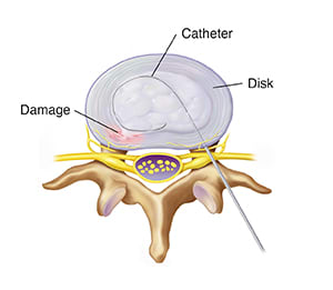 Top view of lumbar vertebra and disk showing needle inserting cathether into disk.