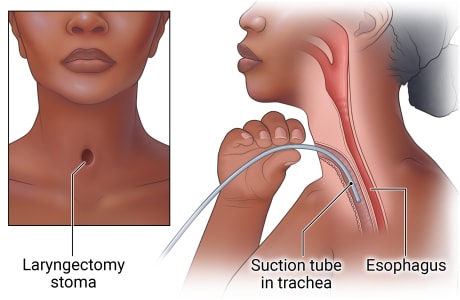 Person with laryngectomy stoma in neck, with side view of person inserting suction tube through stoma and into trachea, with esophagus also shown.