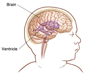 Side view of infant's head showing brain and ventricle.