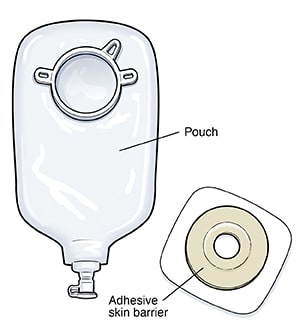 Two-piece drainable urostomy pouch.
