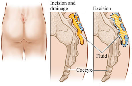 Abscessed pilonidal cyst at top of crease between buttocks, with detail of cyst cut open and drained, and detail of cyst removed.