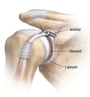 Front view of shoulder joint showing tear at top of labrum. Anchor placed to repair tear.