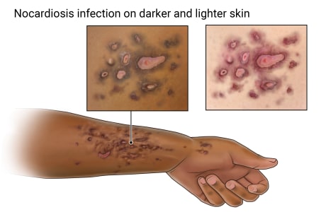 Nocardiosis infection on forearm and wrist, with close-ups of sores on lighter and darker skin.